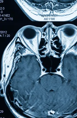 Traumatic Brain Injury